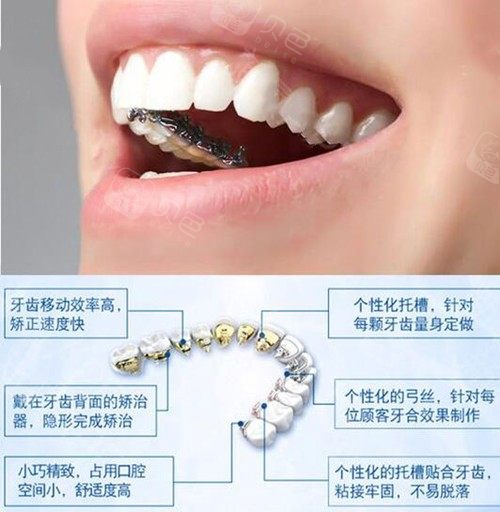 一篇get牙套的种类和价格表,让你选牙齿矫正器不再有烦恼!