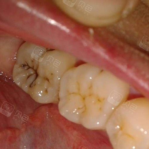 3m流体树脂 恢复时间  10天 收藏 日常刷牙时,经常会看到牙齿上有小
