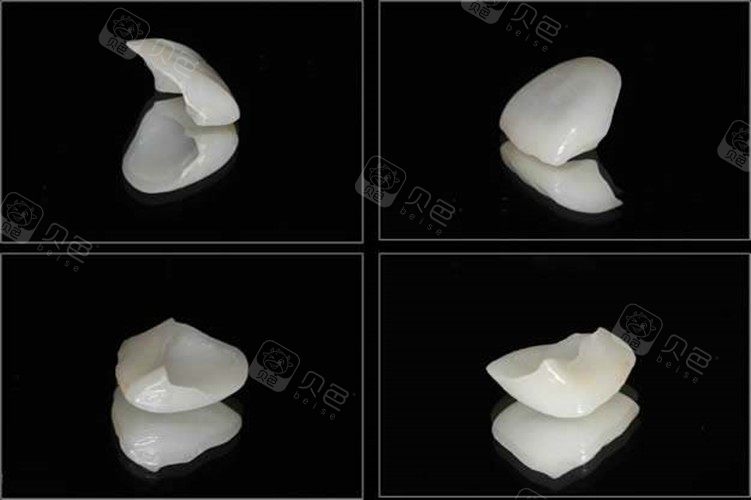 一字之差的铸瓷和全瓷贴面区别有哪些,你造吗