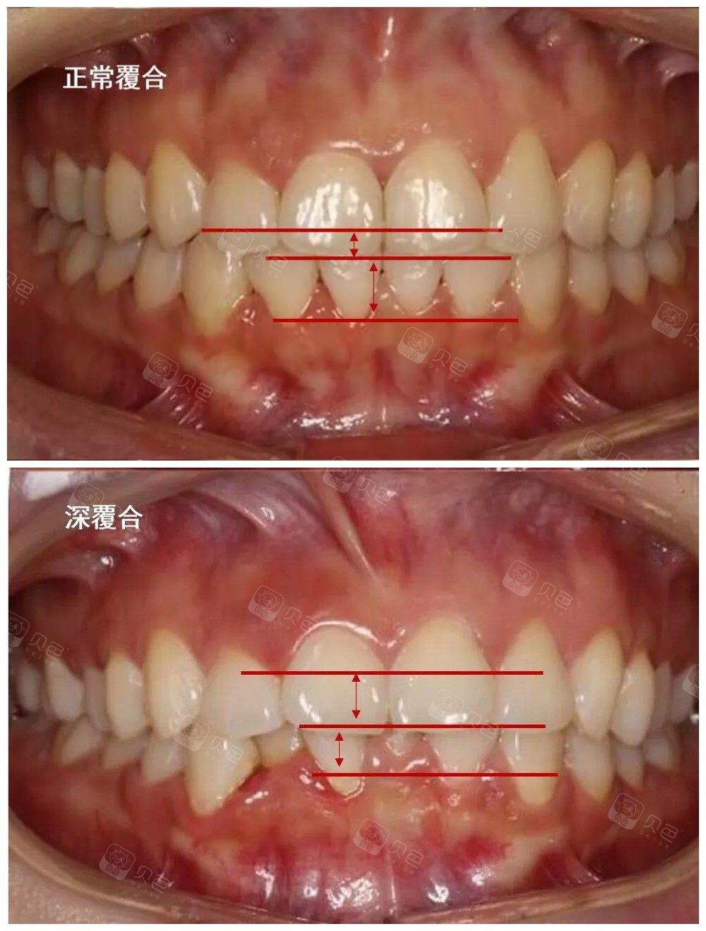 3分钟认清深覆盖和深覆合的区别,矫正前后脸型变化只是其一