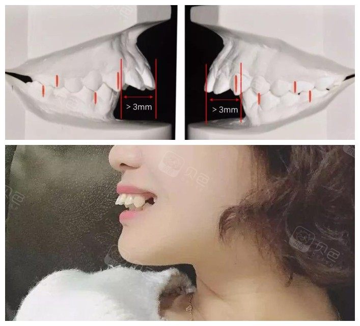 3分钟认清深覆盖和深覆合的区别,矫正前后脸型变化只是其一