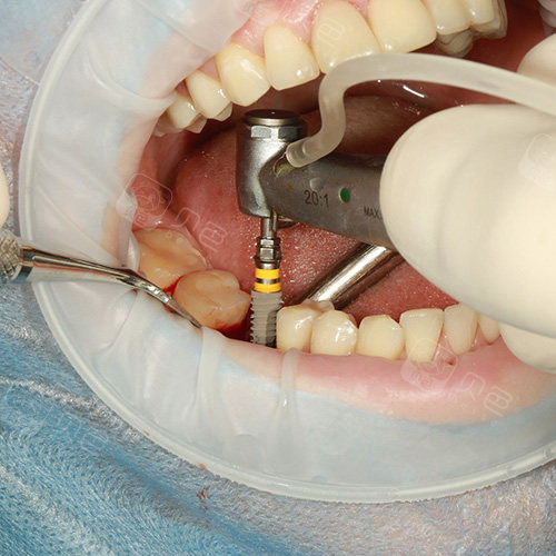 种植牙是医生重要还是种植体重要?哪个影响使用寿命? - 贝色口腔