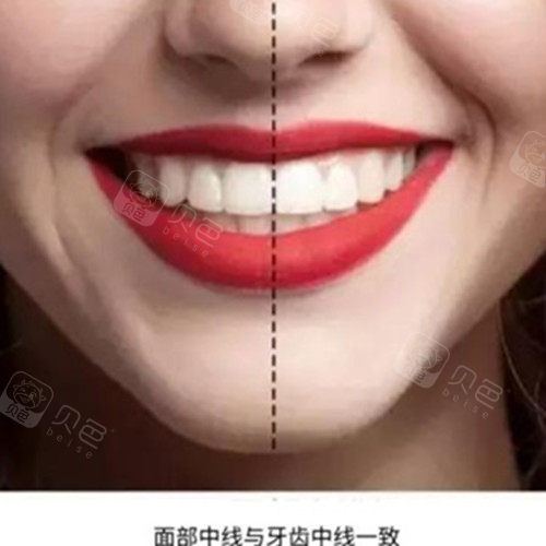 牙齿中缝不齐一定要重视,怎么矫正是门学问哦!