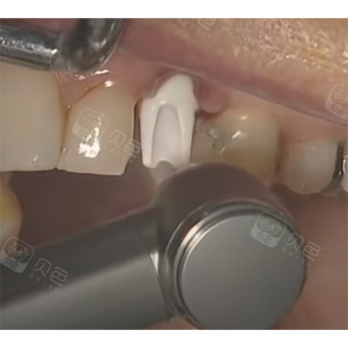 种植牙1年后的感受,告诉你为什么不建议年轻人种奥齿泰