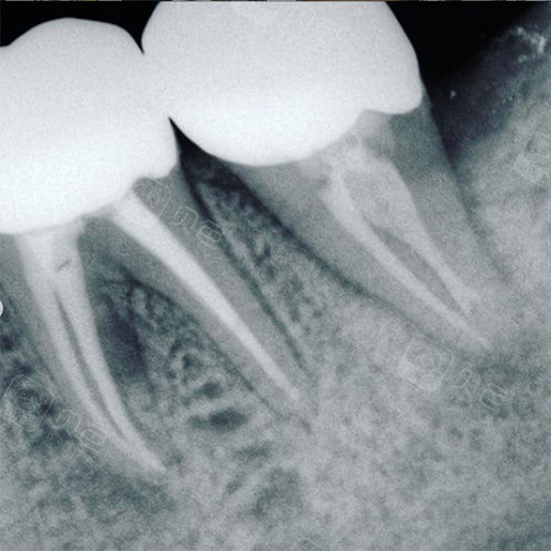 根管治疗后牙片
