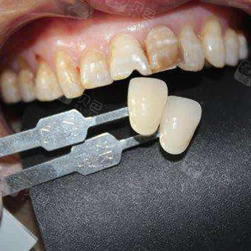 北京哪些口腔医院做烤瓷牙技术好,和全瓷牙区别是什么?