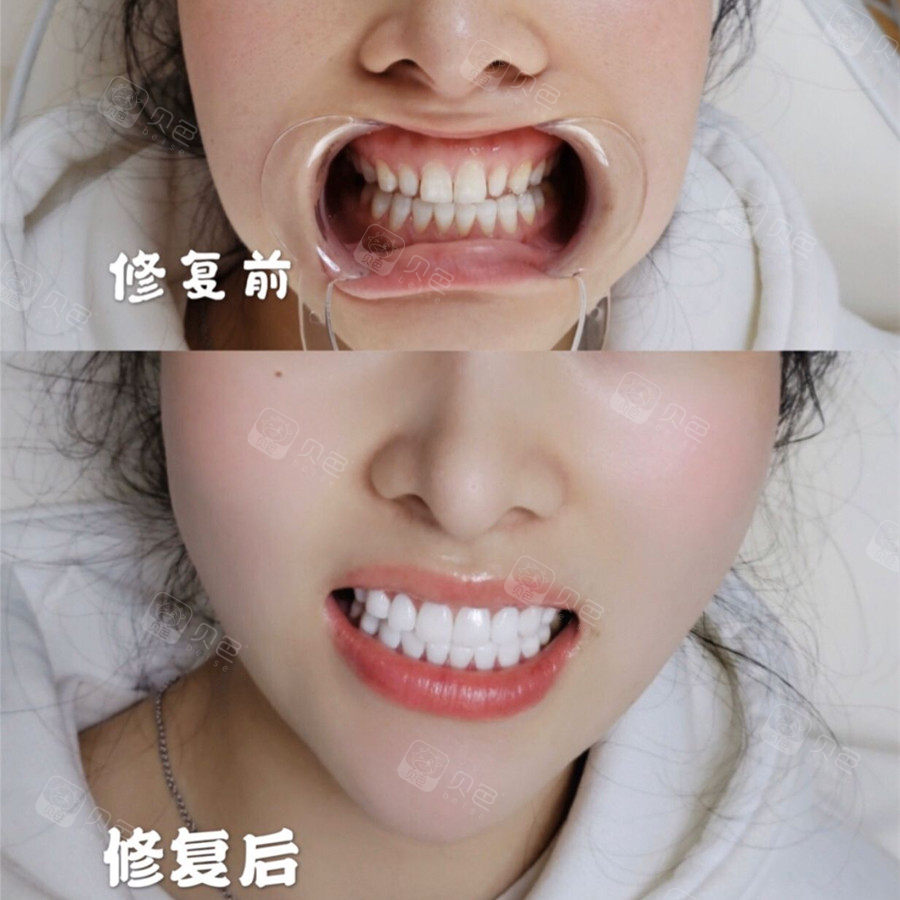 终于把牙缝补起来了好开心!纠结了好久!