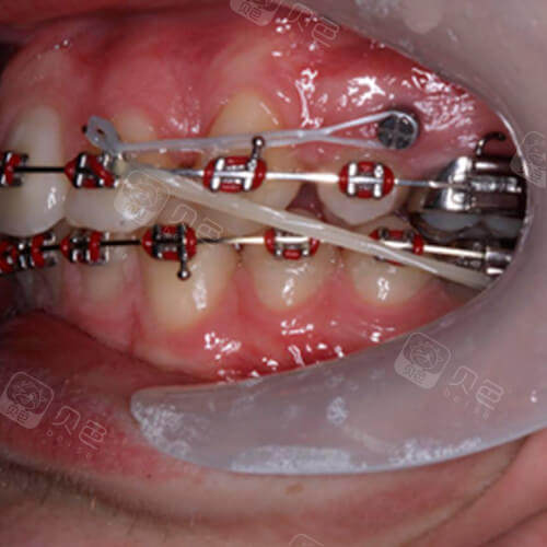 打支抗钉到底疼不