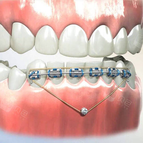 打支抗钉到底疼不