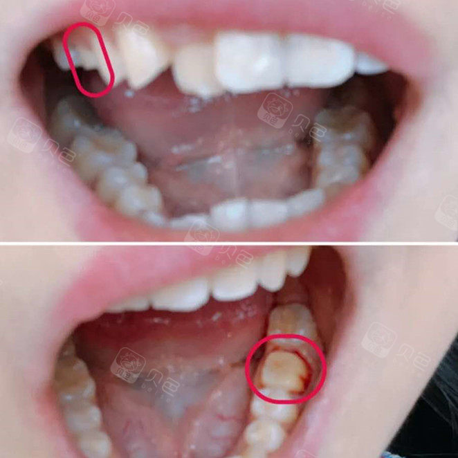 根管治疗以后一定要做牙冠,小伙伴要记住哦