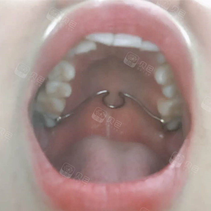 分享带横腭杆的感受给大家