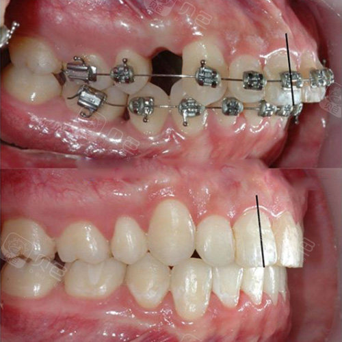 牙齿矫正要先拔牙吗?能不能尽量不拔牙?