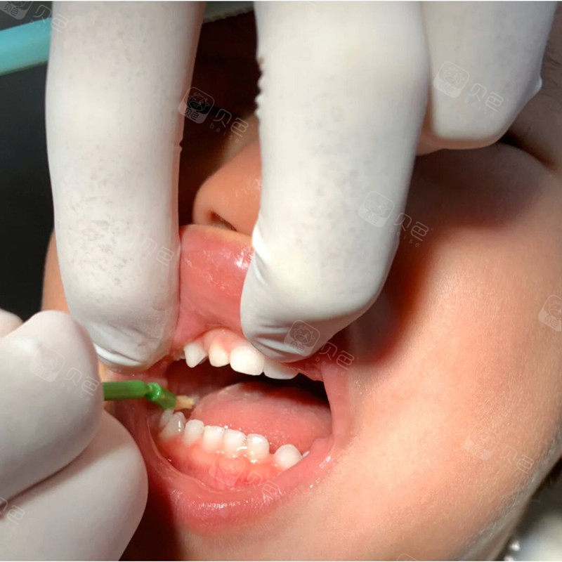 一岁五个月宝宝第一次牙齿涂氟,必须表扬一下