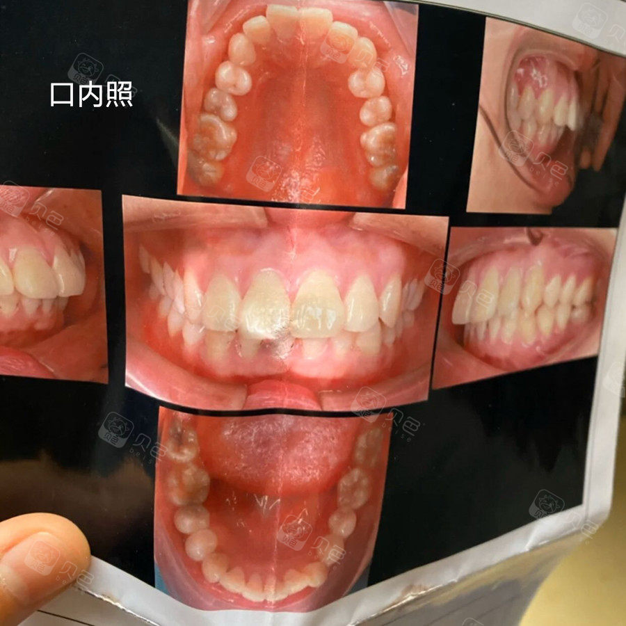 骨性龅牙 深覆合的我开启了牙齿正畸之路