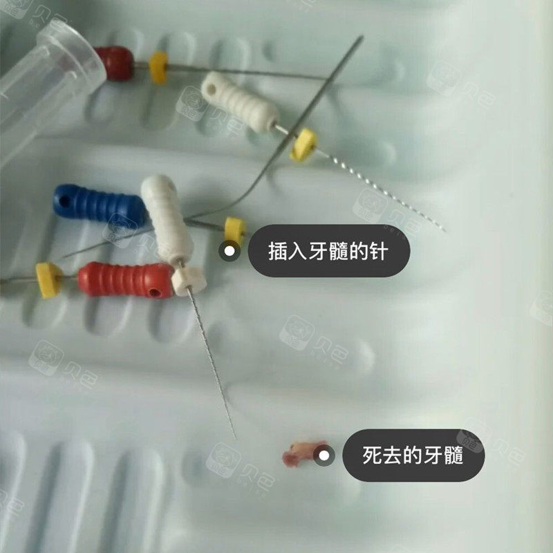 分享我的两颗牙根管治疗十牙冠心得