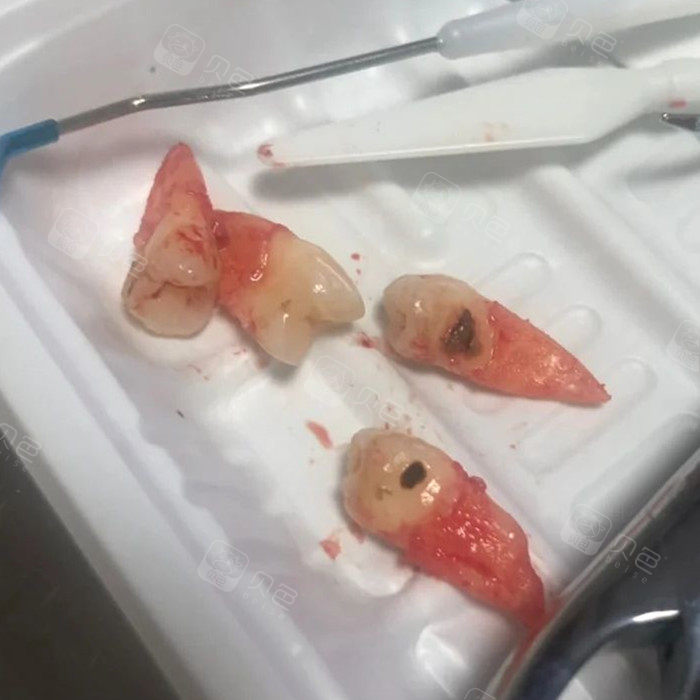 一次性拔掉四颗正常牙齿厉害不