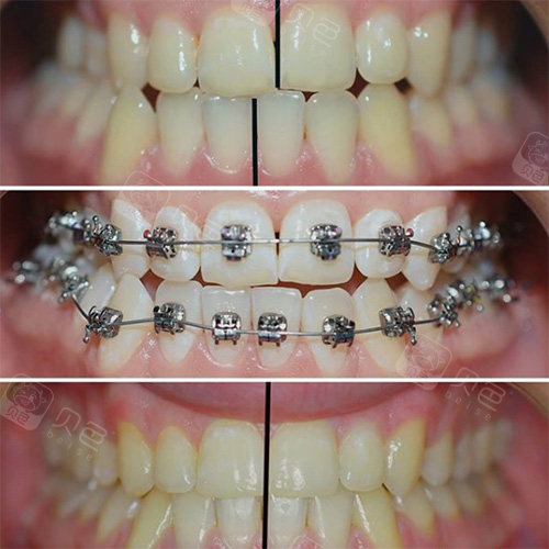 我的牙齿矫正经历,难以回收的下排牙坑惨我了!