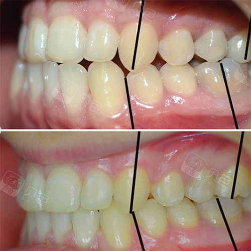 牙齿矫正侧面前后对比