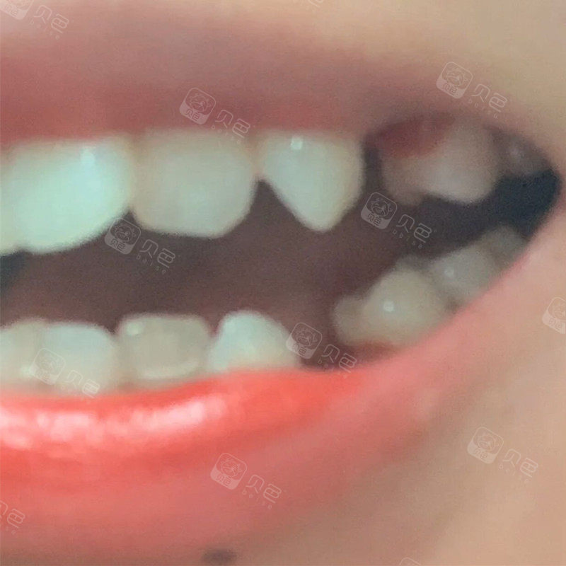 第二次拔出4号牙,这是一篇正畸问题答疑帖