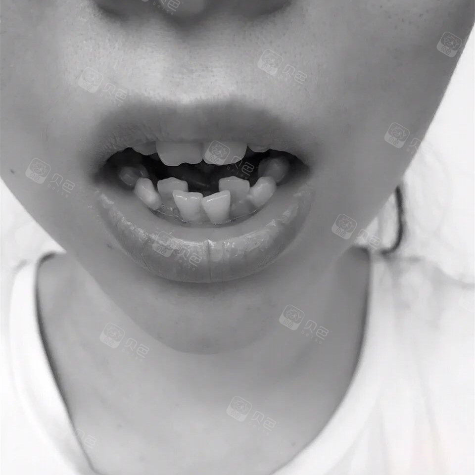 我是一个爱笑的女孩子,每次一笑,就能看到那一排东倒西歪的牙齿,吓得