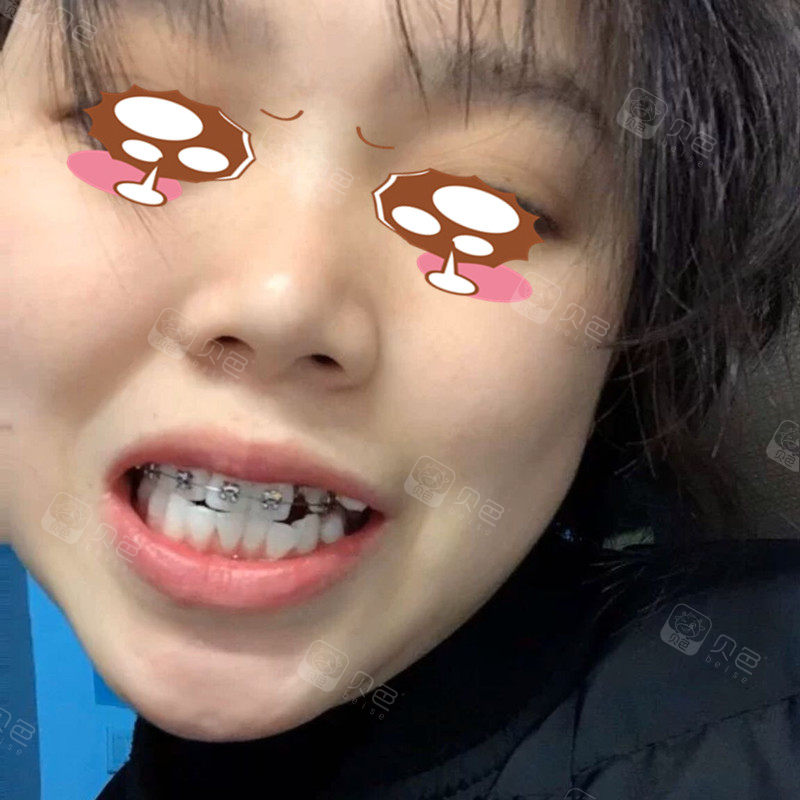 牙齿拥挤还有龅牙,矫正内收嘴凸效果显著!