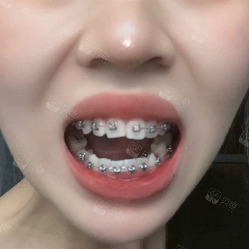 姐妹们带牙套晚上睡觉会很用力咬后槽牙吗?