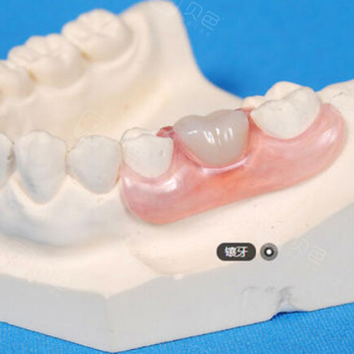 建议镶牙不要种牙是为什么?
