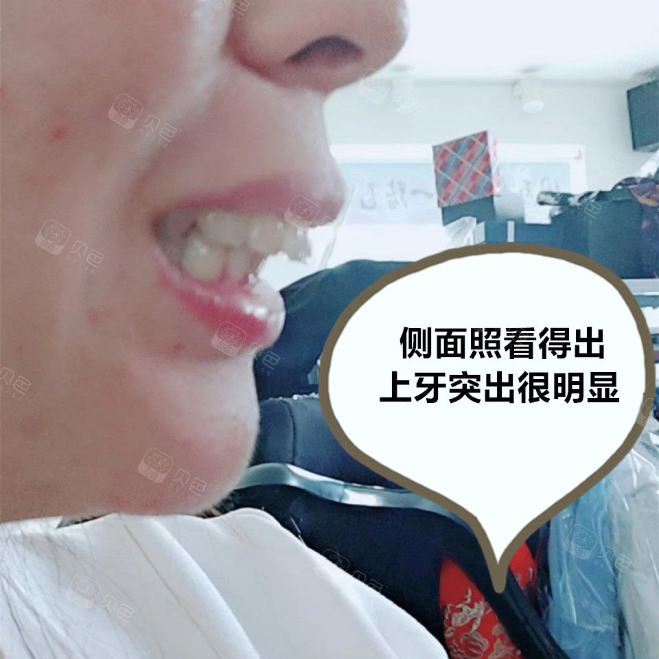 上牙突出好难看,矫正后效果好吗?