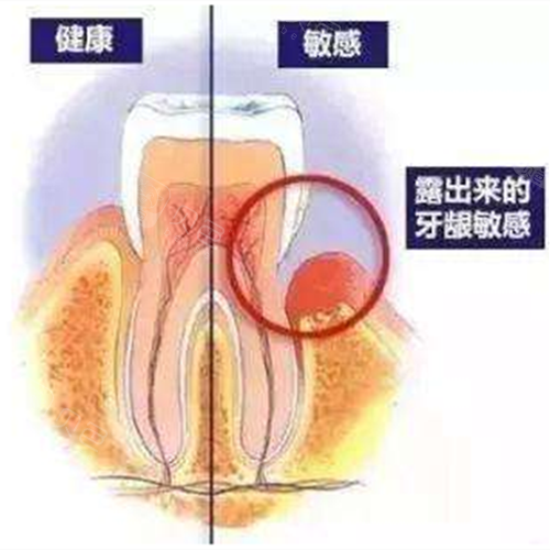 听医生说游离龈这是怎么回事?不治疗是不是也能恢复