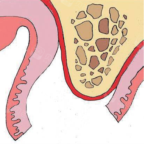 听医生说游离龈这是怎么回事?不治疗是不是也能恢复