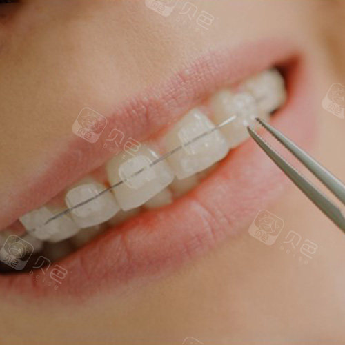 医生为什么不推荐陶瓷牙套?因为太厚而且容易掉?