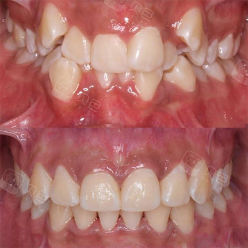 你们谁知道有虎牙的怎么矫正,不能拔!拔了会让嘴巴塌陷
