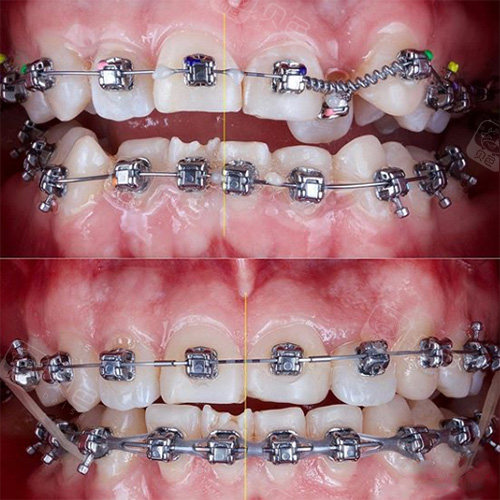 矫正牙齿中牙套上加了个小弹簧是干嘛的?