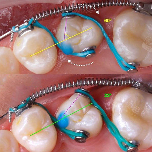 矫正牙齿中牙套上加了个小弹簧是干嘛的?