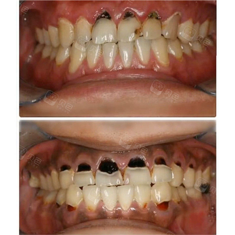 爱喝可乐的我看到这个牙齿得了牙齿酸蚀症真的怕了