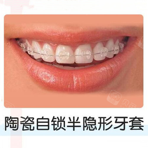 市面上5款牙套种类优劣区别对比自锁式托槽式隐形矫正5选1