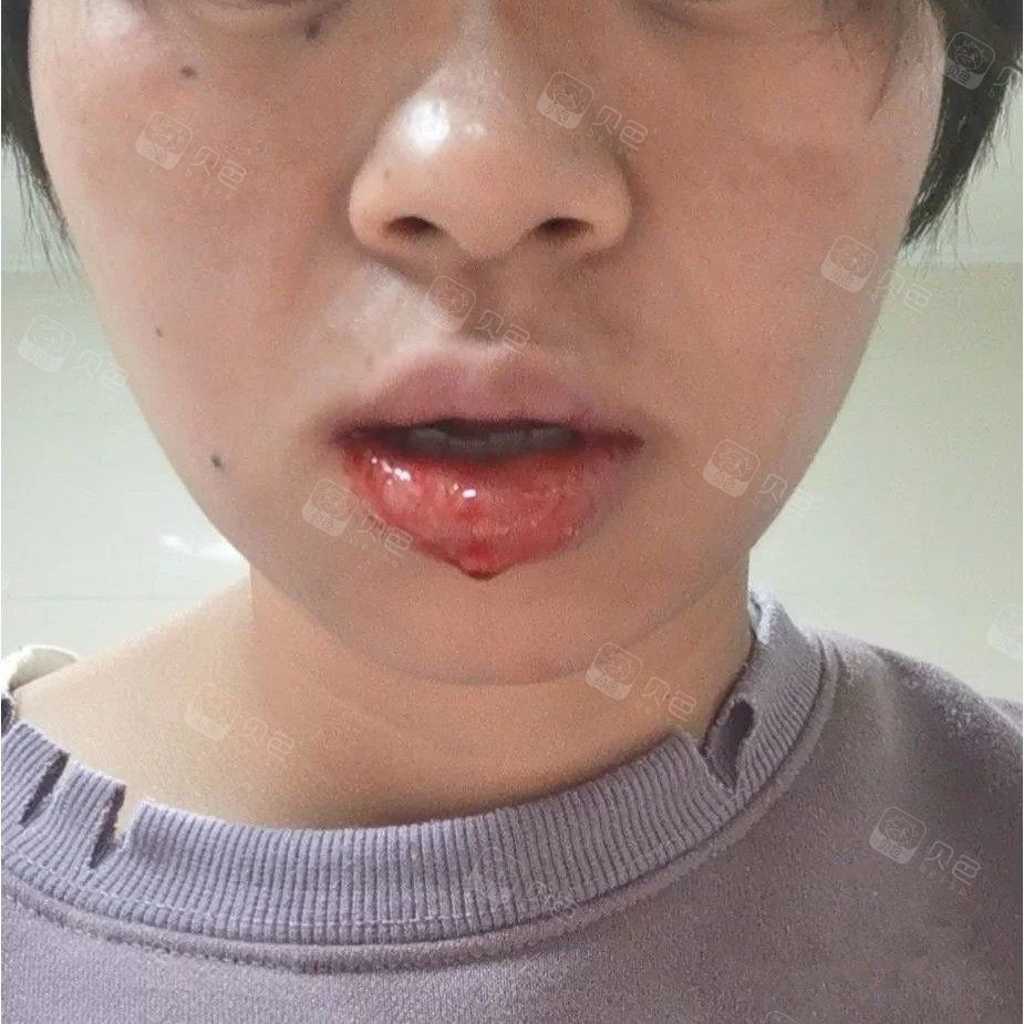 为了牙齿矫正,宝妈我连拔8颗牙