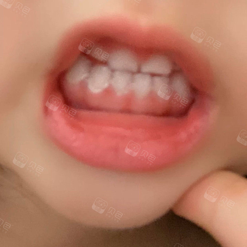 儿童地包天矫正真的越早越容易看看我宝宝2个月的效果