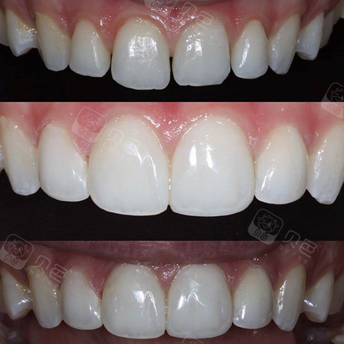 千万别做树脂牙齿贴面?为什么不少人都diss树脂贴面?