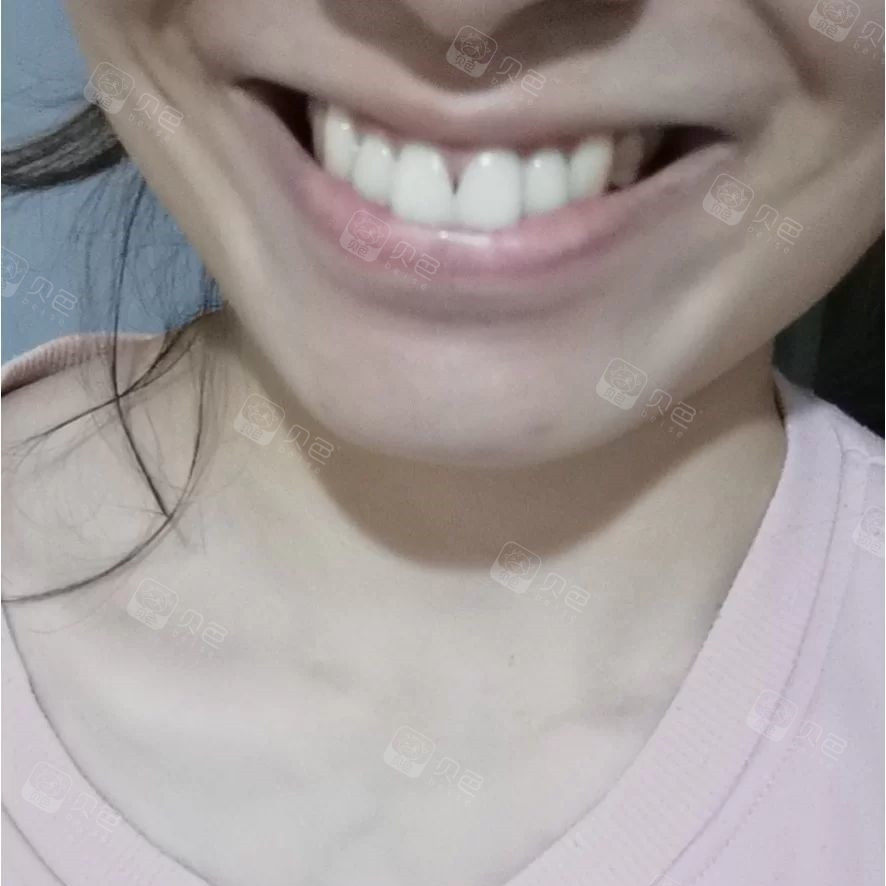 牙齿能不矫正就别矫正?我这种情况呢?