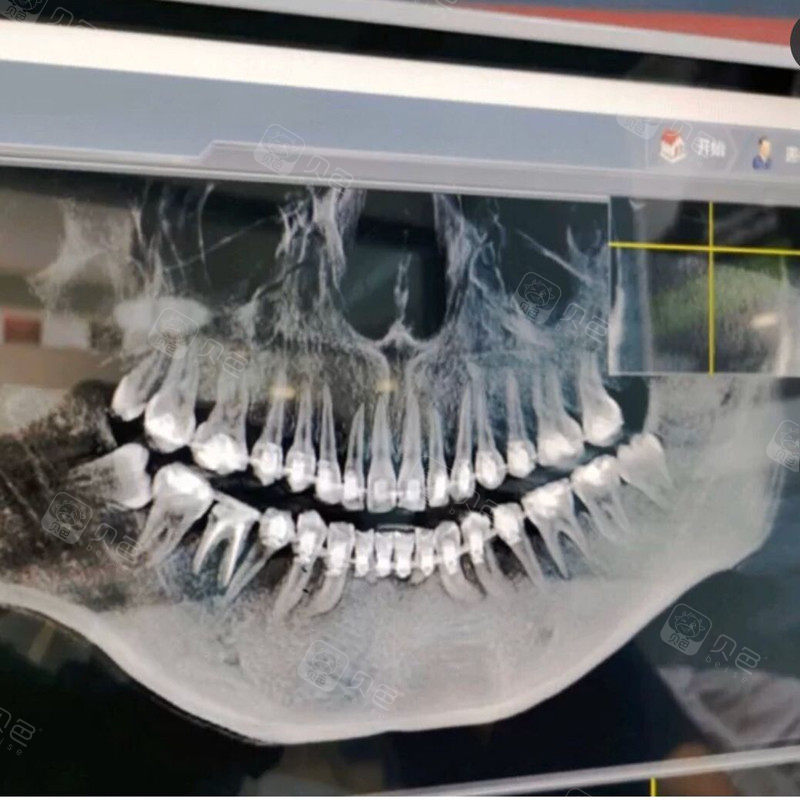 带了牙套导致牙根吸收了!找谁理赔?