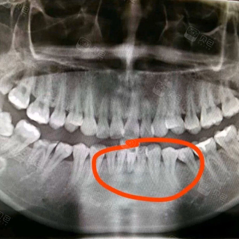 带了牙套导致牙根吸收了!找谁理赔?