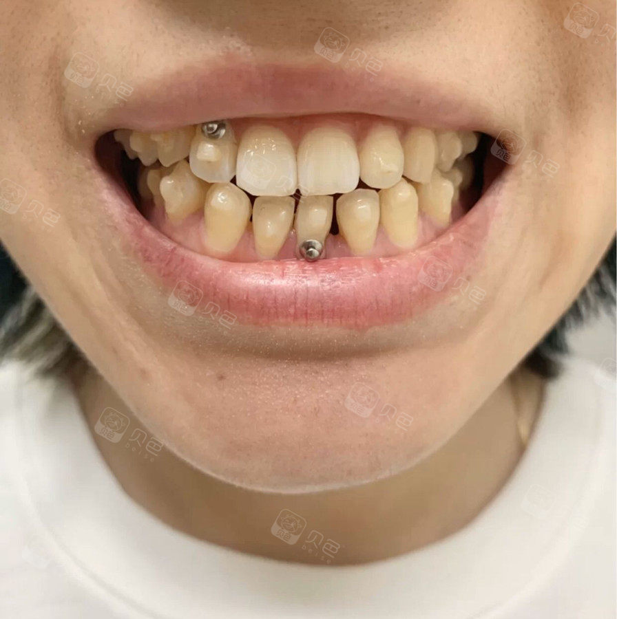 牙齿矫正打支抗钉