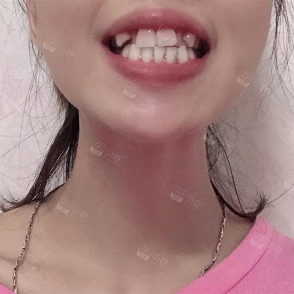 戴牙套一般要戴多久才合适呢?