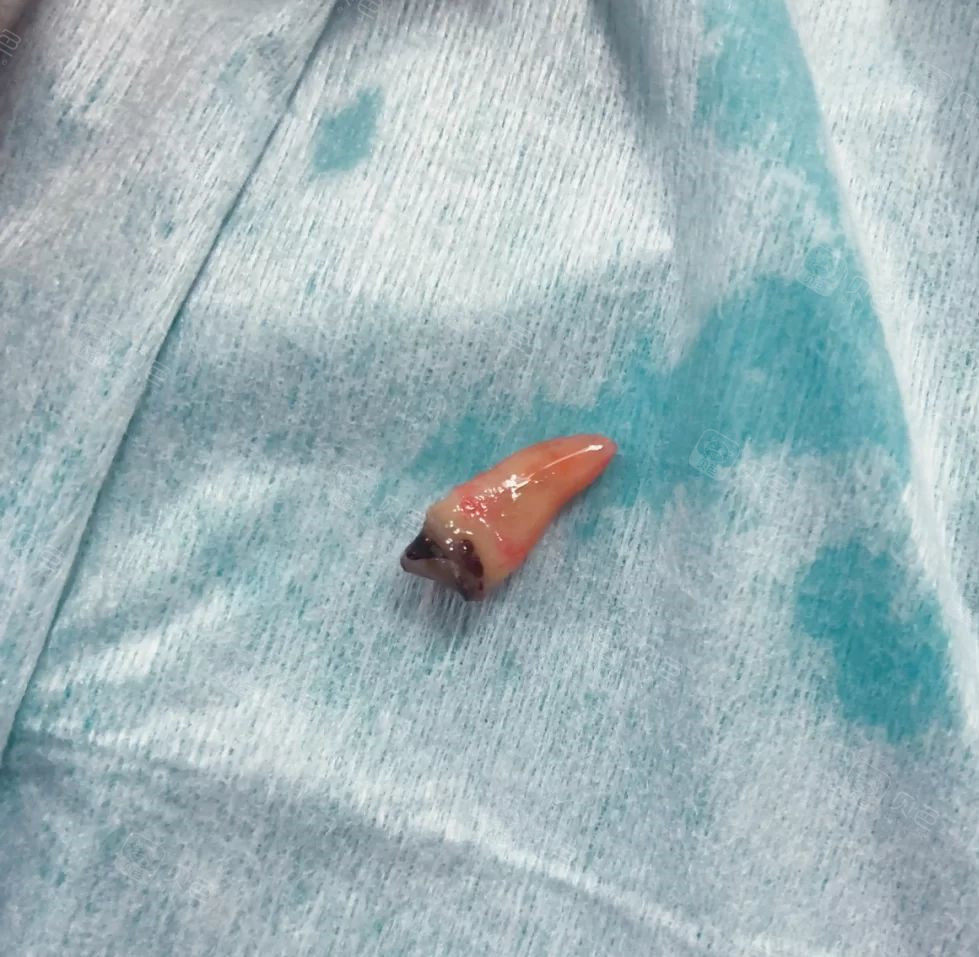 拔掉的烂牙根