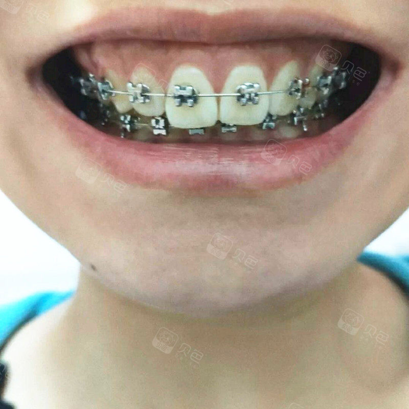 矫正两年多深覆合了,自认为矫正失败医生说弄不了