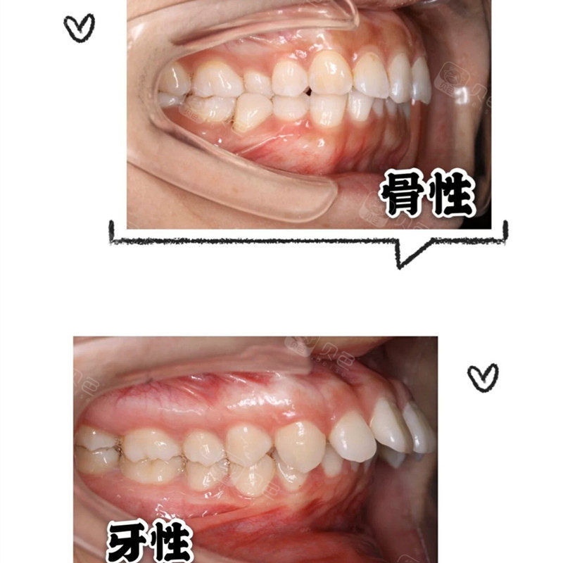 小小牙医科普:龅牙自测指南!牙性骨性自己能判断!