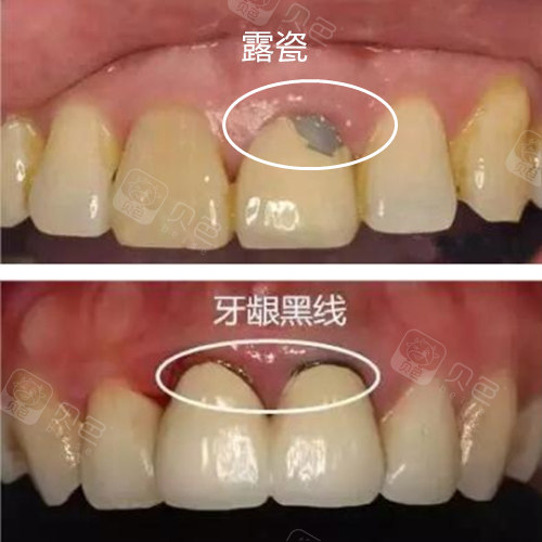 从牙冠里含不含金属,一眼都能看出烤瓷牙和全瓷牙的区别