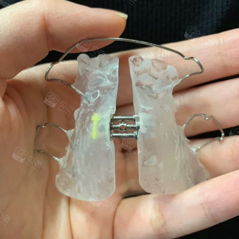 牙齿正畸前要戴上颌扩弓器一个月一直更新中