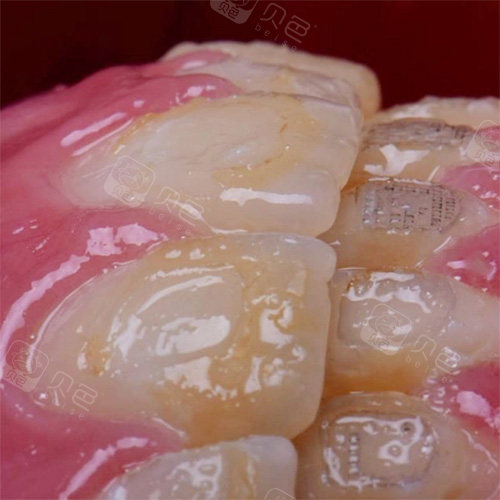 摘牙套过程高清大图分享,粘牙套的胶水原来是这样去掉的!